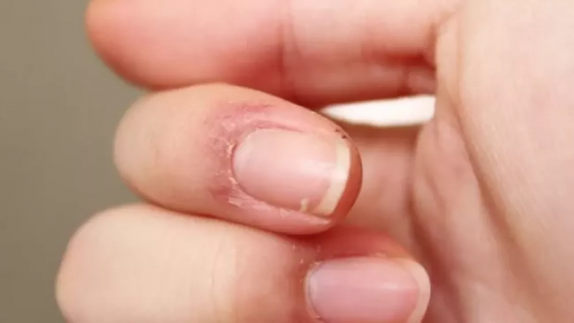 Tırnaklarınıza iyi bakın! O hastalığın habercisi olabilir - Resim: 3