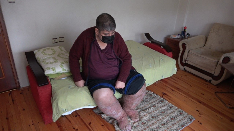 Sivrisinek ısırığı hayatını kararttı - Resim: 1