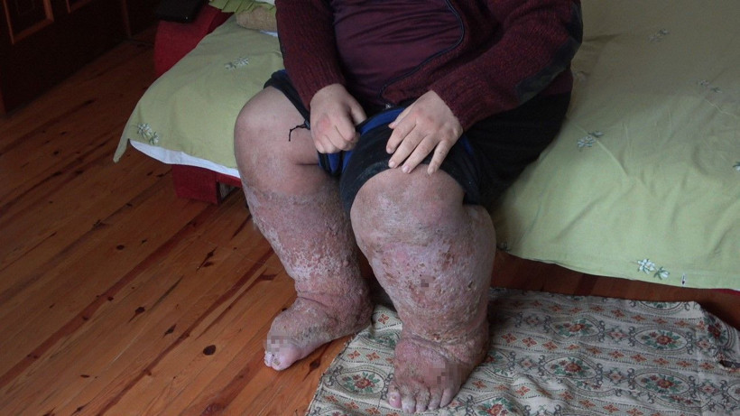 Sivrisinek ısırığı hayatını kararttı - Resim: 3