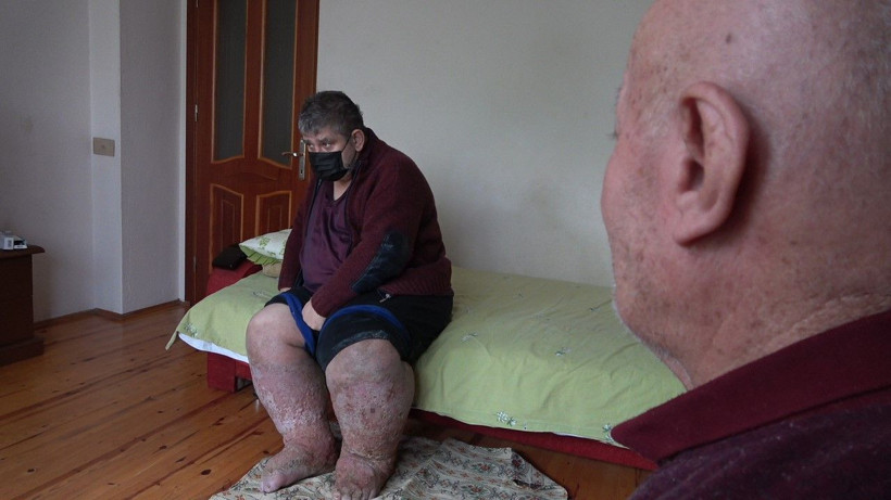 Sivrisinek ısırığı hayatını kararttı - Resim: 4