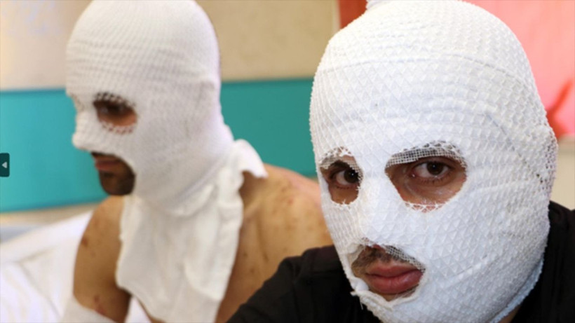 Erzurum'da çakmak doldururken hastanelik oldular - Resim: 3