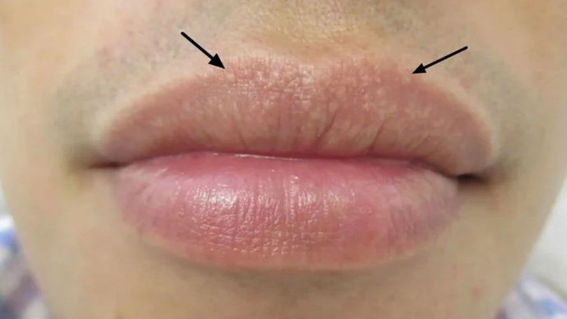 Dudaklarınızdaki bu görüntüye çok dikkat edin! Bakın nedeni neymiş - Resim: 1