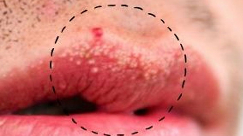 Dudaklarınızdaki bu görüntüye çok dikkat edin! Bakın nedeni neymiş - Resim: 3