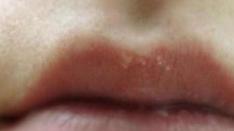 Dudaklarınızdaki bu görüntüye çok dikkat edin! Bakın nedeni neymiş - Resim: 4