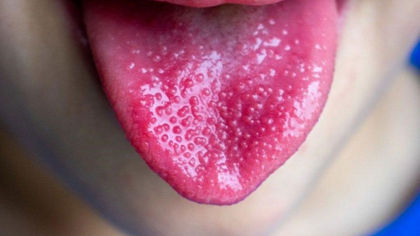 Dil rengi böyle olanlara kötü haber! Hemen aynaya bakın - Resim: 2