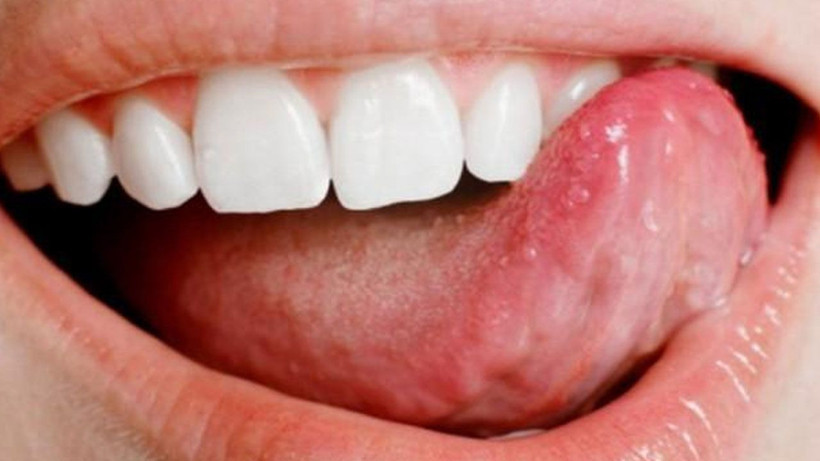 Dil rengi böyle olanlara kötü haber! Hemen aynaya bakın - Resim: 4