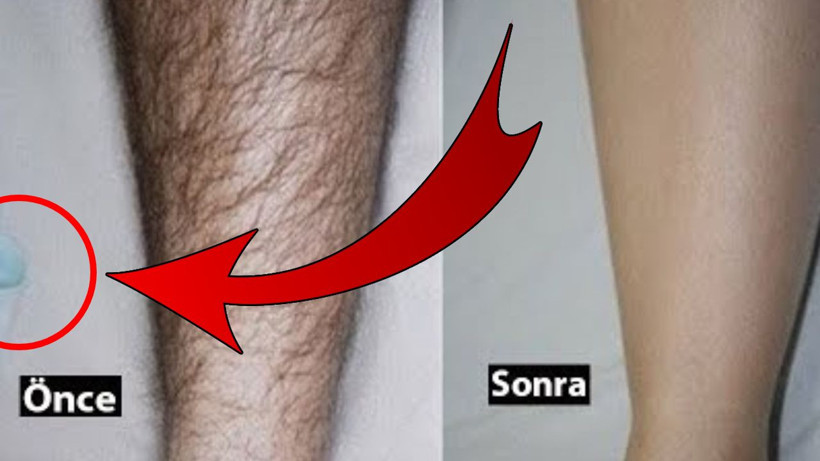 Kollardaki istenmeyen tüyleri yok ediyor. Anında etkili acısız doğal yöntem… - Resim: 1