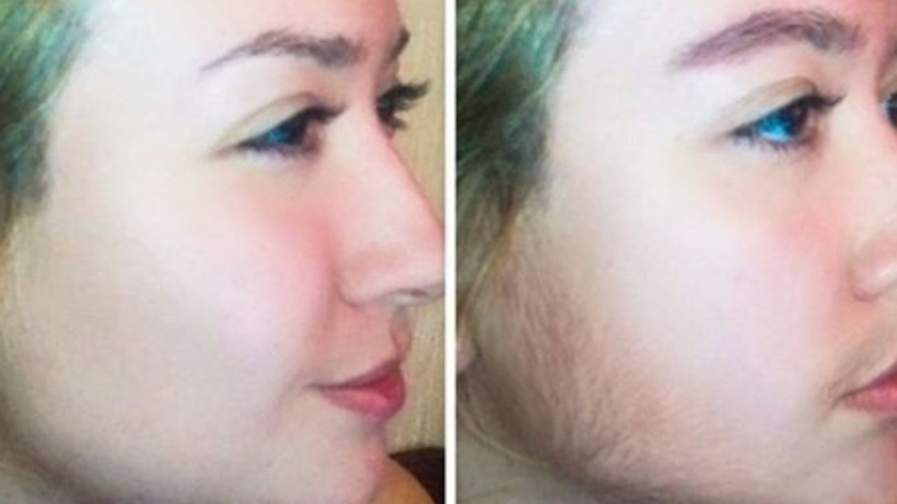 Yeniden çıkmıyorlar* Yüzdeki istenmeyen tüyleri doğal yollarla yok eden yöntem- iz kalmıyor - Resim: 1