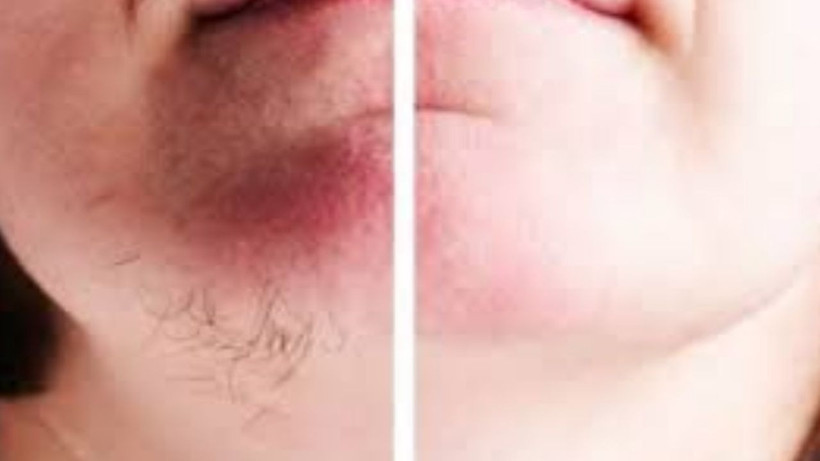 Yeniden çıkmıyorlar* Yüzdeki istenmeyen tüyleri doğal yollarla yok eden yöntem- iz kalmıyor - Resim: 3