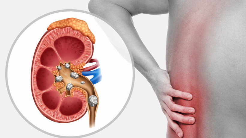 Böbrek taşı sancısı çekenler dikkat! 8 mm'den büyük taşları bile düşürüyor - Resim: 2