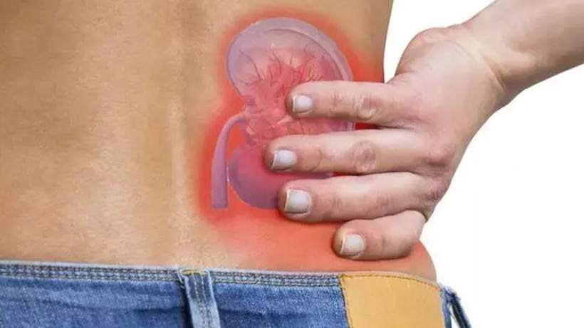 Böbrek taşı sancısı çekenler dikkat! 8 mm'den büyük taşları bile düşürüyor - Resim: 3