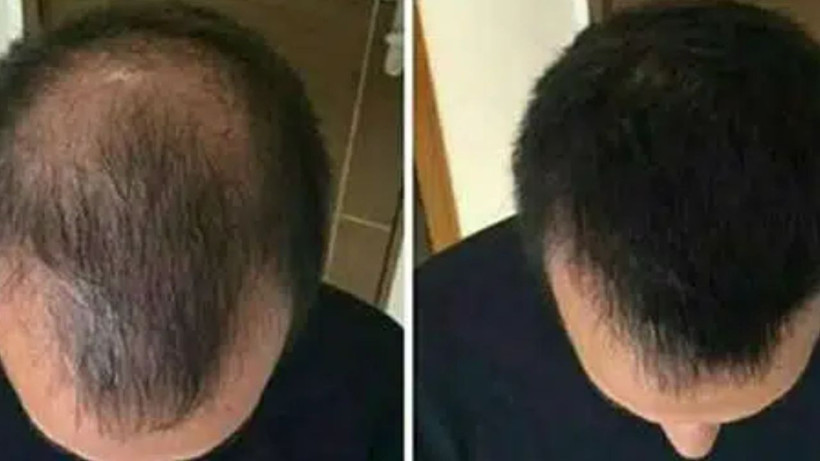 Berberler biliyor ama söylemiyordu* saç dökülmesini anında kesiyor - Resim: 4