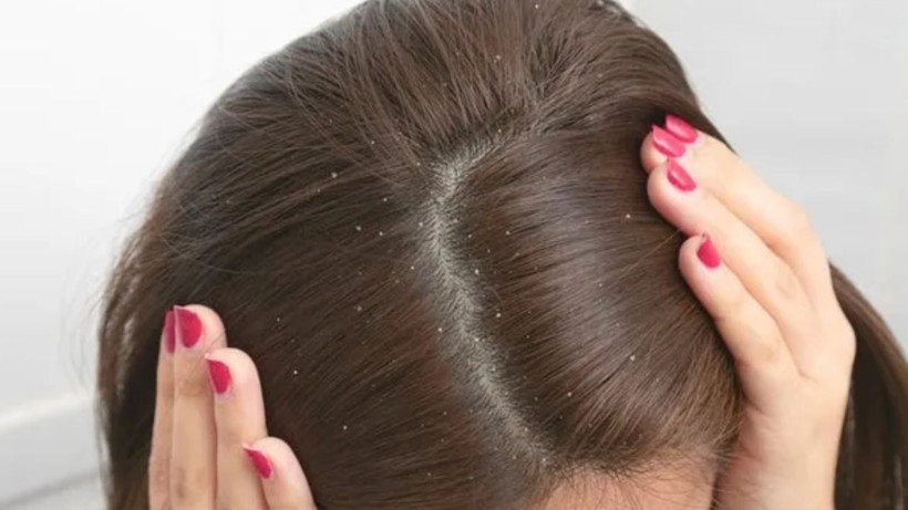 Berberler biliyor ama söylemiyordu* saç dökülmesini anında kesiyor - Resim: 1