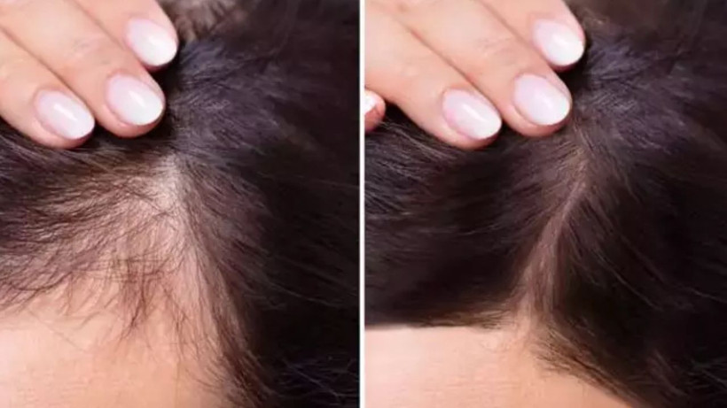 Saç dökülmesinin önlemenin 4 püf noktası- 1 tel bile asla dökülmüyor - Resim: 1