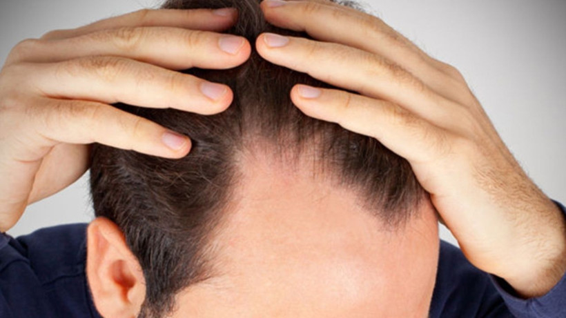 Saç dökülmesinin önlemenin 4 püf noktası- 1 tel bile asla dökülmüyor - Resim: 4