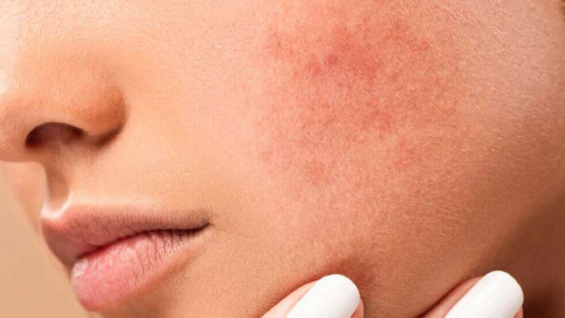 Cilt lekelerini adeta silgi gibi silip temizliyor! Kaşık kaşık yiyenler farkı gördü - Resim: 1