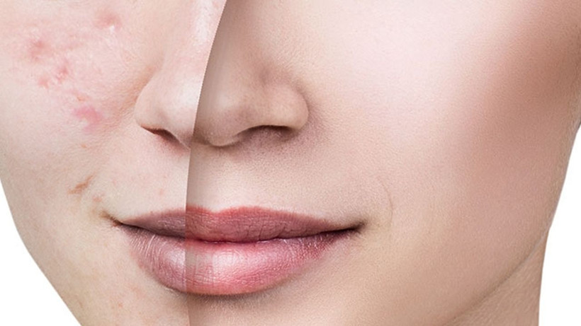 Cilt lekelerini adeta silgi gibi silip temizliyor! Kaşık kaşık yiyenler farkı gördü - Resim: 2