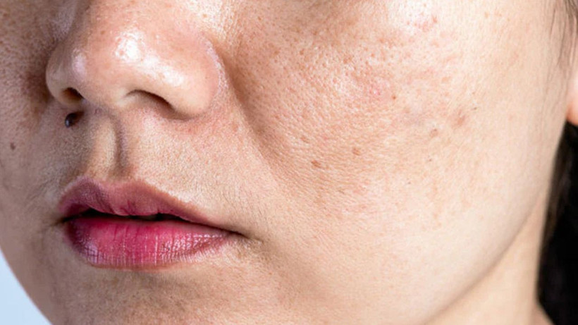 Cilt lekelerini adeta silgi gibi silip temizliyor! Kaşık kaşık yiyenler farkı gördü - Resim: 3