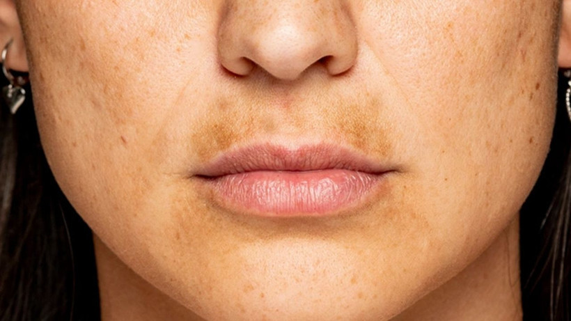 Cilt lekelerini adeta silgi gibi silip temizliyor! Kaşık kaşık yiyenler farkı gördü - Resim: 4