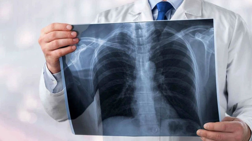 Türkiye'de her yıl 45 bin yeni vaka! Bu illere dikkat: Risk daha fazla! - Resim: 1