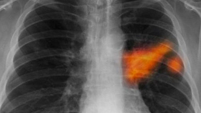 Türkiye'de her yıl 45 bin yeni vaka! Bu illere dikkat: Risk daha fazla! - Resim: 3