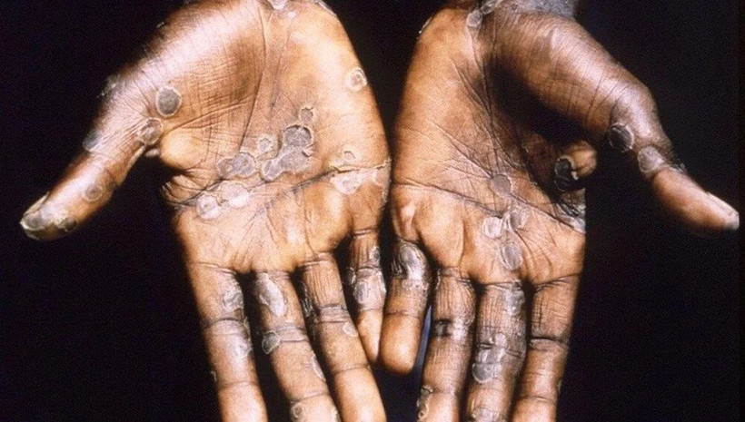 6 soruda maymun çiçeği virüsü hakkında merak edilenler: Belirtileri nedir? Evcil hayvana bulaşır mı? - Resim: 1