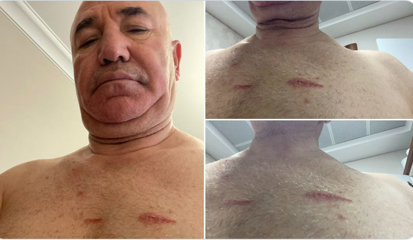 Mahmut Tanal vücudundaki darp izlerini paylaştı: “Hukuk devleti yaralandı” - Resim: 1