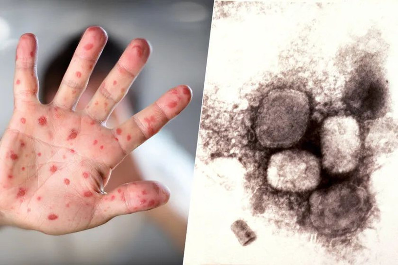 Sağlık Bakanlığı 'maymun çiçeği virüsü' için rehber yayınladı - Resim: 1