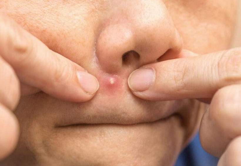 Dr. Mehmet Öz uyardı: Yüzünüzdeki “ölüm üçgeni”ni kurcalamayın! - Resim: 3