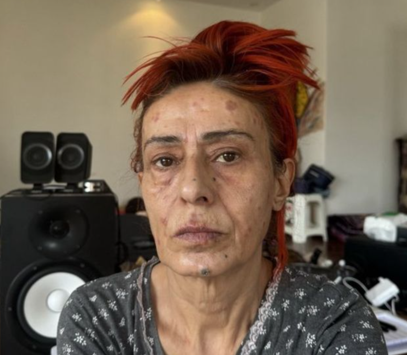 Yıldız Tilbe'nin yüzü yandı! Çareyi maske takmakta buldu - Resim: 2