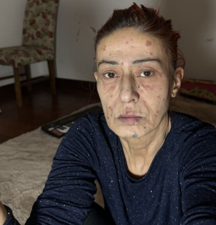 Yıldız Tilbe'nin yüzü yandı! Çareyi maske takmakta buldu - Resim: 1